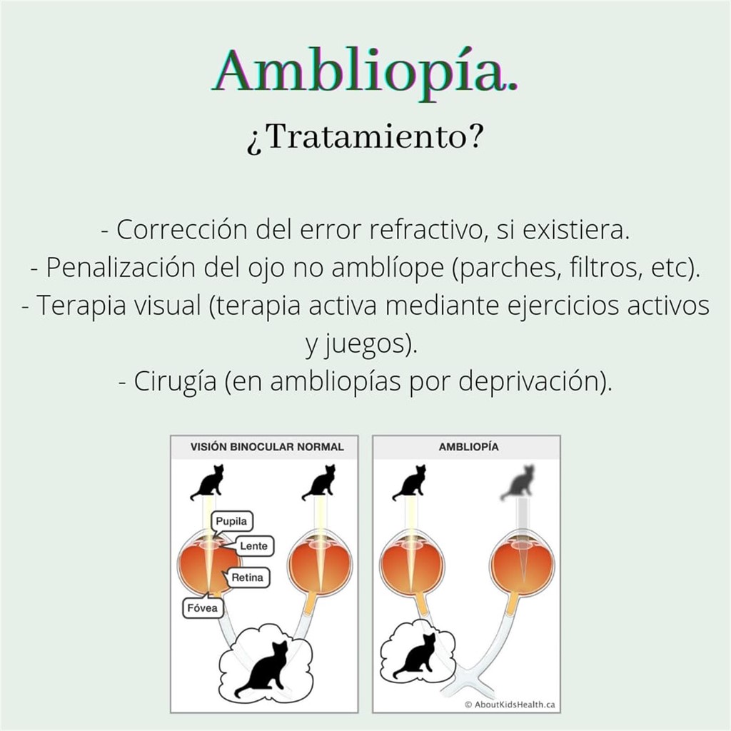 Ambliopía. ¿Tratamiento?