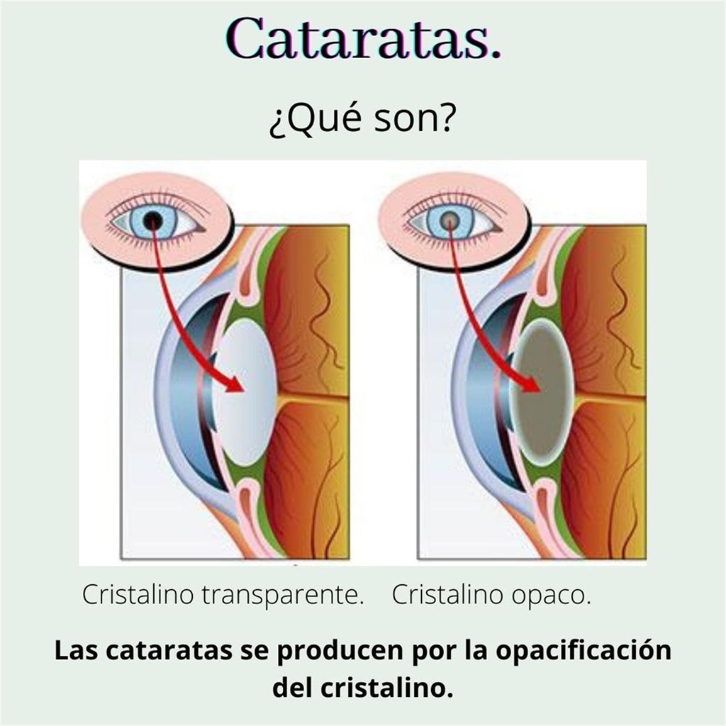 Cataratas. ¿Qué son?