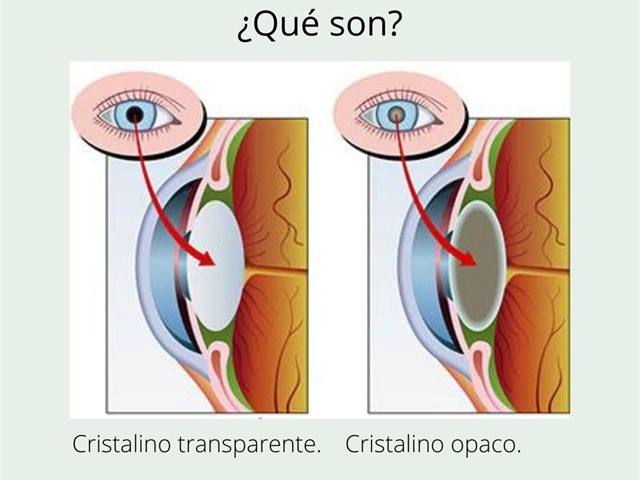 Cataratas. ¿Qué son?