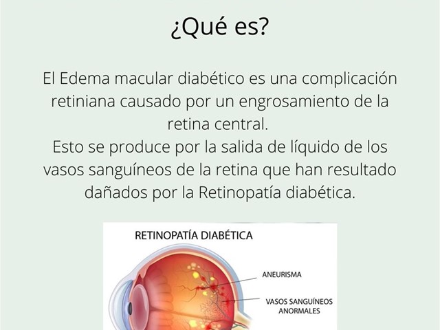 Edema macular diabético.