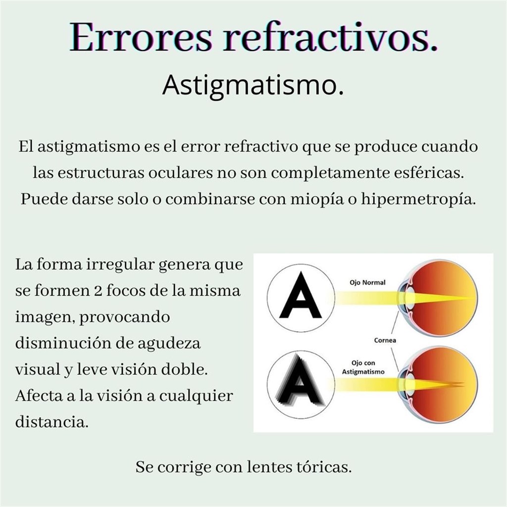 Errores refractivos: Astigmatismo.