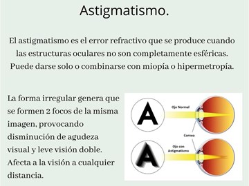 Errores refractivos: Astigmatismo.