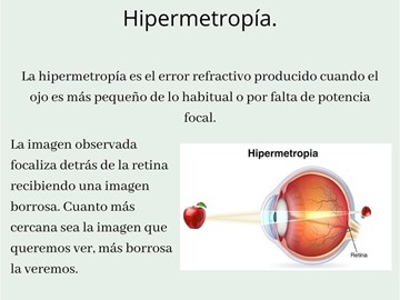 Errores refractivos: Hipermetropía.