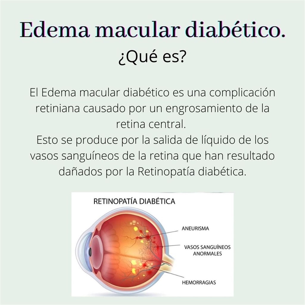 Edema macular diabético.