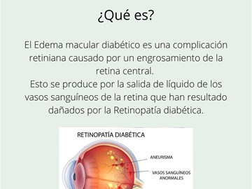 Edema macular diabético