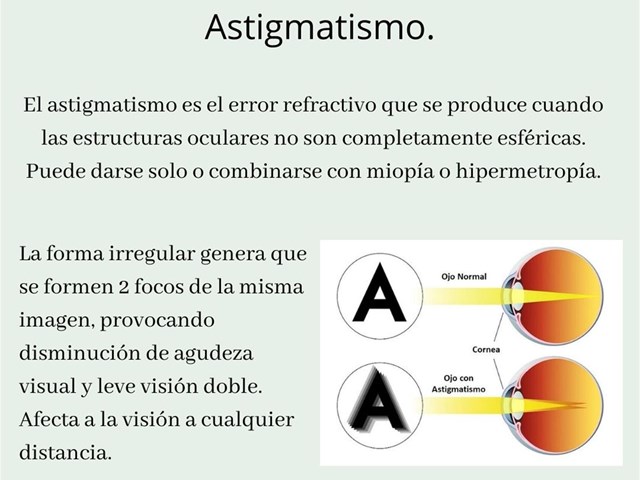 Erros de refracción: astigmatismo.