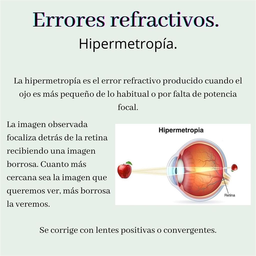 Erros de refracción: hipermetropía.