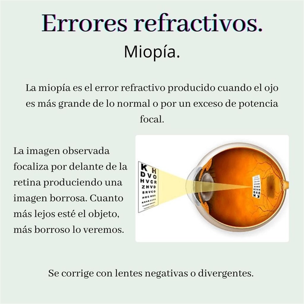Erros de refracción: Miopía.
