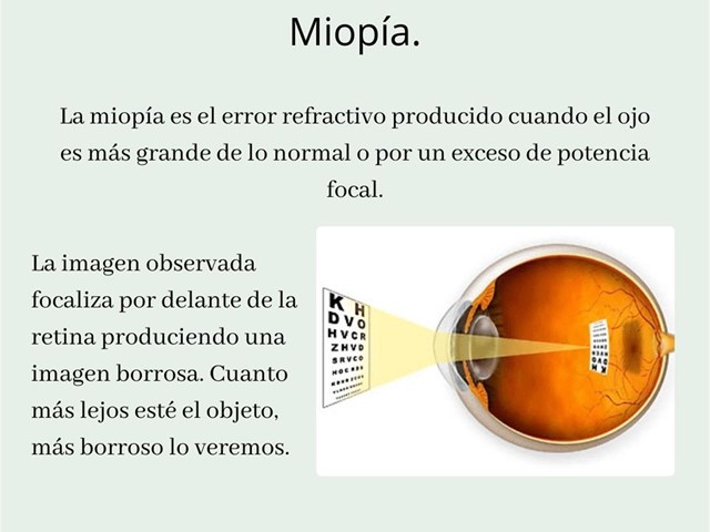 Erros de refracción: Miopía.