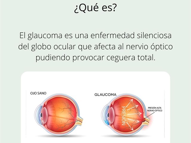 Glaucoma, ¿cómo prevenirlo?